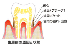 歯周病の原因と状態