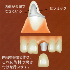 セラモメタル（メタルボンド）イメージ