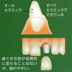 オールセラミッククラウンイメージ