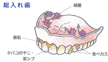 総入れ歯