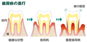 歯周病の進行