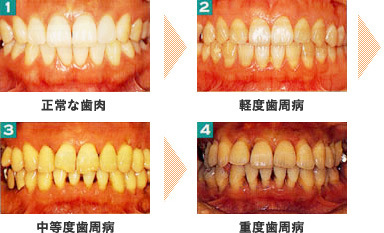 歯周病イメージ写真