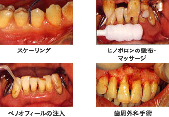 歯周病治療イメージ写真