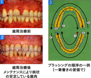 歯周病治療後イメージ